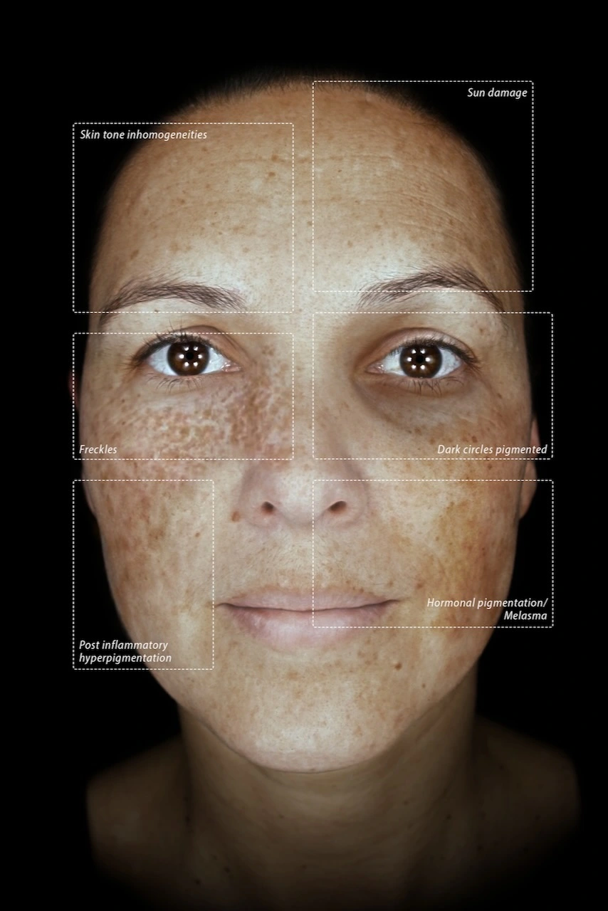 Pigmentation