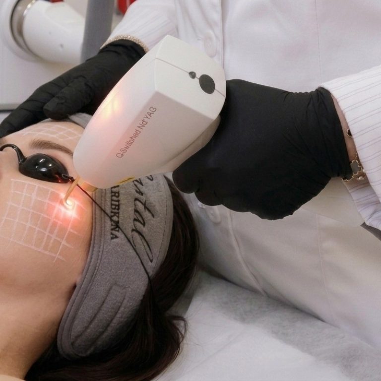 הצערת העור בעזרת לייזר פרקציונלי Lumenis M22